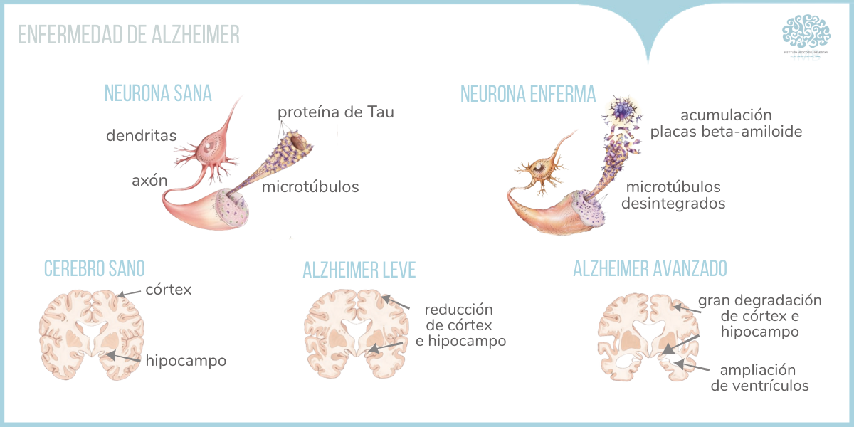 alzheimer-demencia-sueno-vigilia
